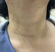 體表無疤痕已不再是夢  認識內視鏡甲狀腺切除手術(相關圖片)