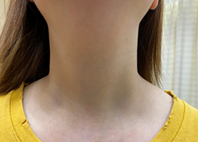 體表無疤痕已不再是夢  認識內視鏡甲狀腺切除手術(相關圖片)