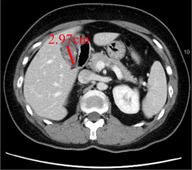 達文西單孔膽囊切除手術    藏疤、減痛、加速復原  膽囊疾病新選擇(相關圖片)