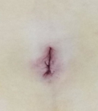 達文西單孔膽囊切除手術    藏疤、減痛、加速復原  膽囊疾病新選擇(相關圖片)