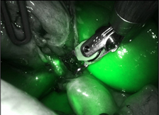 達文西單孔膽囊切除手術    藏疤、減痛、加速復原  膽囊疾病新選擇(相關圖片)