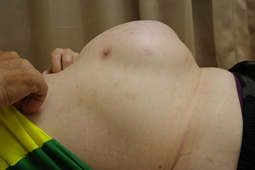 術後凸肚腰痠不需再忍耐    達文西微創腹壁疝氣修復手術重拾體態與活動力(相關圖片)