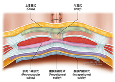 術後凸肚腰痠不需再忍耐    達文西微創腹壁疝氣修復手術重拾體態與活動力(相關圖片)