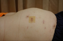 術後凸肚腰痠不需再忍耐    達文西微創腹壁疝氣修復手術重拾體態與活動力(相關圖片)