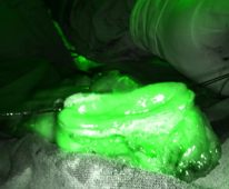 微創手術的新紀元  達文西機械手臂應用於大腸直腸手術  (相關圖片)