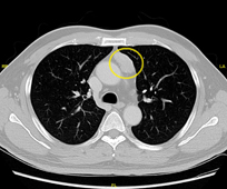 為何總是，力不從心？     重症肌無力應用達文西輔助全胸腺切除手術的優勢(相關圖片)