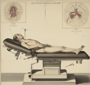 為何總是，力不從心？     重症肌無力應用達文西輔助全胸腺切除手術的優勢(相關圖片)