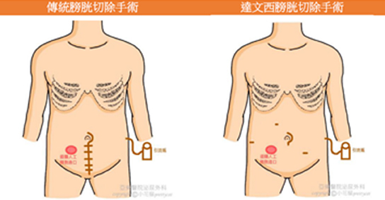 達文西膀胱切除手術  重塑健康新起點(相關圖片)