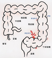 腸道健康錦囊  認識大腸憩室炎(相關圖片)