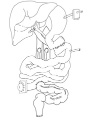 活體小腸移植的突破與展望(相關圖片)