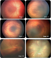 許早產孩子一個「睛彩」的未來   認識早產兒視網膜病變(相關圖片)