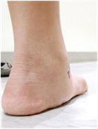 兒童扁平足 別錯過治療的黃金期(相關圖片)