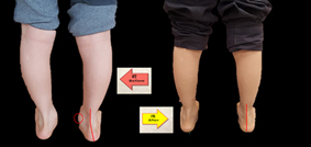 兒童扁平足 別錯過治療的黃金期(相關圖片)