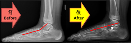 兒童扁平足 別錯過治療的黃金期(相關圖片)