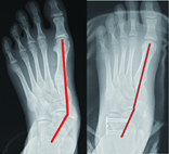 兒童扁平足 別錯過治療的黃金期(相關圖片)