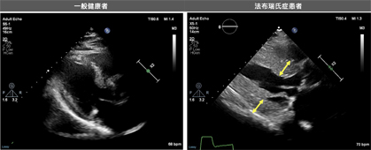 隱身在你我身邊的罕見疾病   法布瑞氏症如何影響心臟健康(相關圖片)