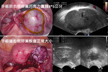 卵巢有巧克力囊腫，還能懷孕嗎？   一篇看懂生育保存關鍵！(相關圖片)