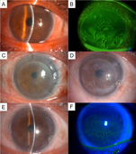 視茫茫 「角膜內皮移植手術」見曙光(相關圖片)