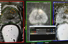 診斷攝護腺癌新利器   談經會陰核磁共振影像融合切片(相關圖片)
