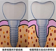 植牙助您重拾咀嚼力  醫師評估不可少?(相關圖片)