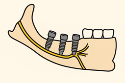 植牙助您重拾咀嚼力  醫師評估不可少?(相關圖片)
