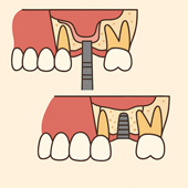 植牙助您重拾咀嚼力  醫師評估不可少?(相關圖片)