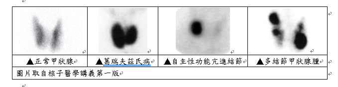 精準掃描＋碘功能檢查  照亮甲狀腺健康路(相關圖片)