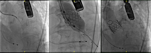 心臟瓣膜「舊換新」免開胸  認識瓣中瓣(ViV)微創手術(相關圖片)