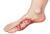 糖尿病足的日常護理 讓您守護雙腳健康(相關圖片)