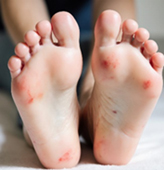 糖尿病足的日常護理  讓您守護雙腳健康(相關圖片)