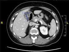 從一場腹痛開始   創傷科團隊與機械手臂的精準革命(相關圖片)