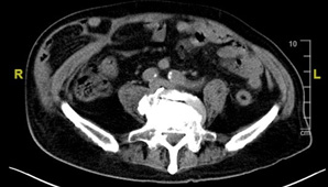 當創傷後，腹壁重建遇上機械手臂   不只活下來，還要好好活下去(相關圖片)