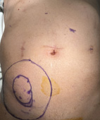 當創傷後，腹壁重建遇上機械手臂   不只活下來，還要好好活下去(相關圖片)