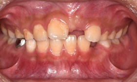 孩子門牙長不出來？ 早期局部矯正改善萌發障礙(相關圖片)