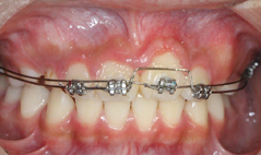 孩子門牙長不出來？ 早期局部矯正改善萌發障礙(相關圖片)
