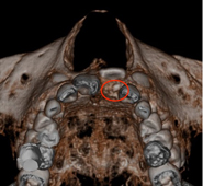 孩子門牙長不出來？ 早期局部矯正改善萌發障礙(相關圖片)