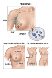 乳癌防治全指南   篩檢策略與精準治療解析(相關圖片)