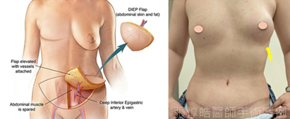 乳癌治療後找回自信 乳房重建的選擇與新趨勢(相關圖片)