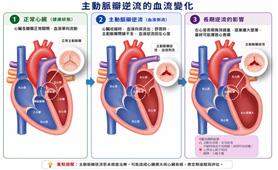 主動脈瓣逆流免開胸？經導管瓣膜治療新契機(相關圖片)