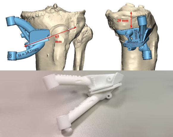 3D列印輔助－高位脛骨截骨矯正手術