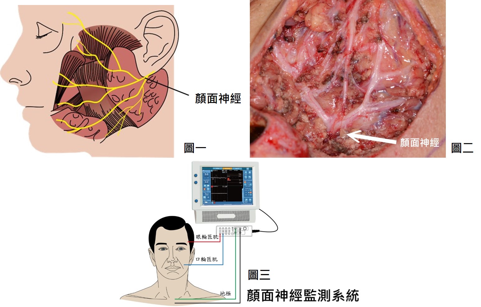顏面神經監測系統